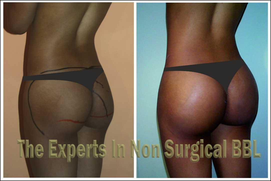 Non-Surgical Butt Lift Before & After Photo of Afro-American Female Patient