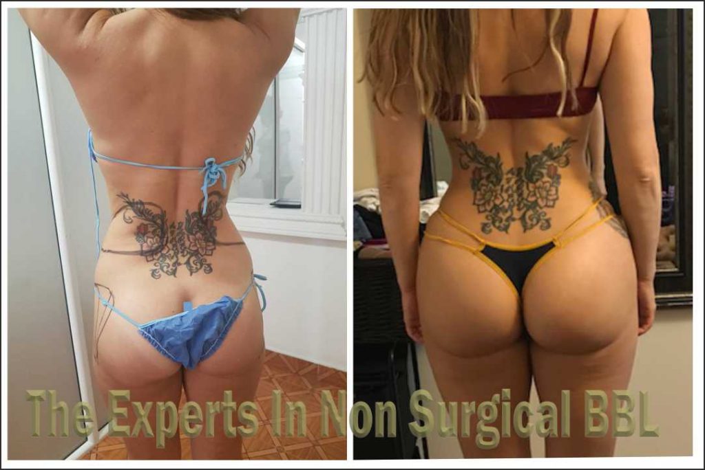 Buttock Augmentation Before & After Photo of Caucasian Female Patient